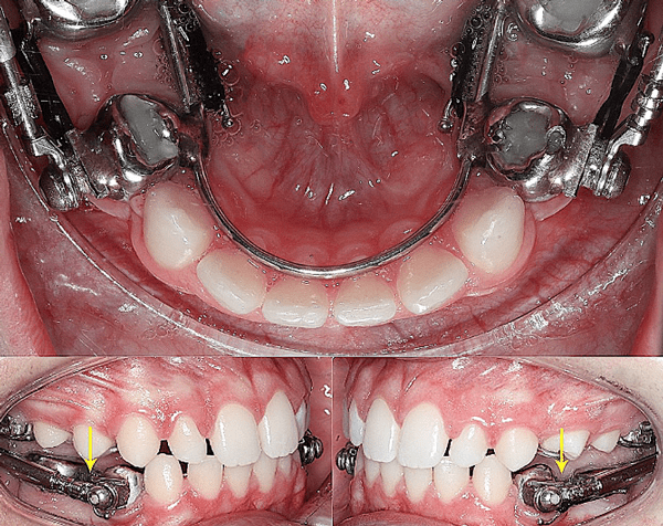 قبل و بعد ارتودنسی فک پایین
