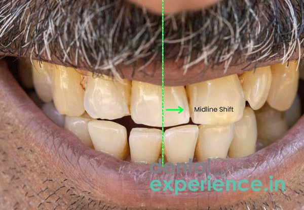 درمان انحراف خط میدلاین دندان 