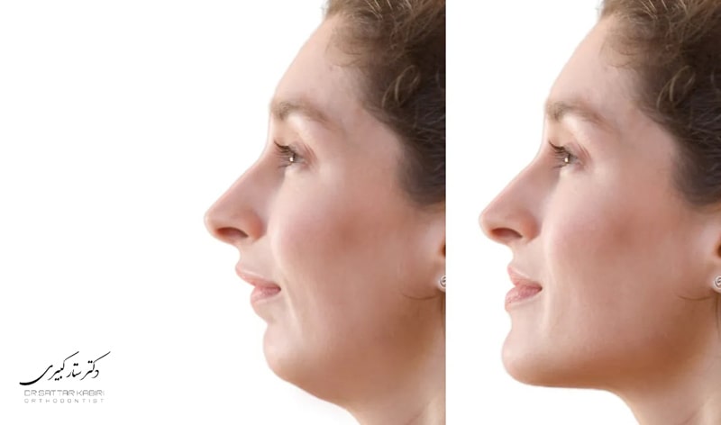 عکس عقب بودن فک پایین