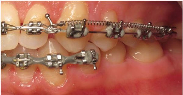 کویل اسپرینگ در ارتودنسی