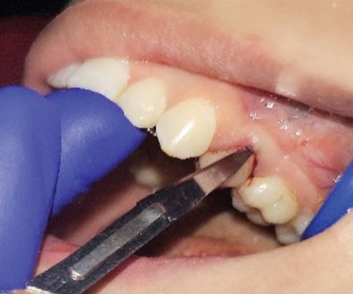 فیبروتومی دندان