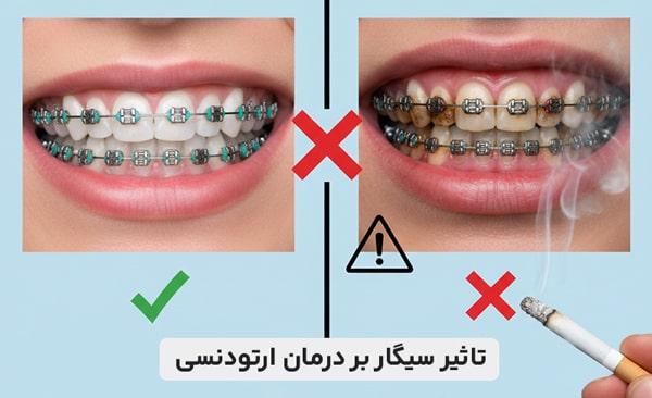 تاثیر سیگار بر درمان ارتودنسی