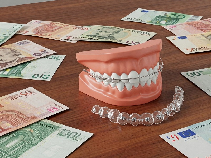 افرادی که بودجه کافی برای ارتودنسی نامرئی دارند