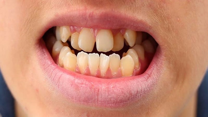 آیا فرزند من نیاز به ارتودنسی دارد