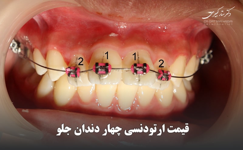 قیمت ارتودنسی چهار دندان جلو