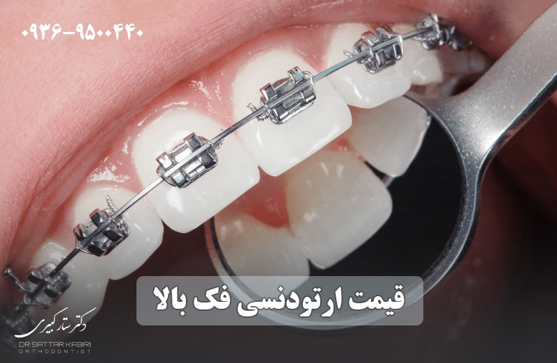 قیمت ارتودنسی دندان فک بالا