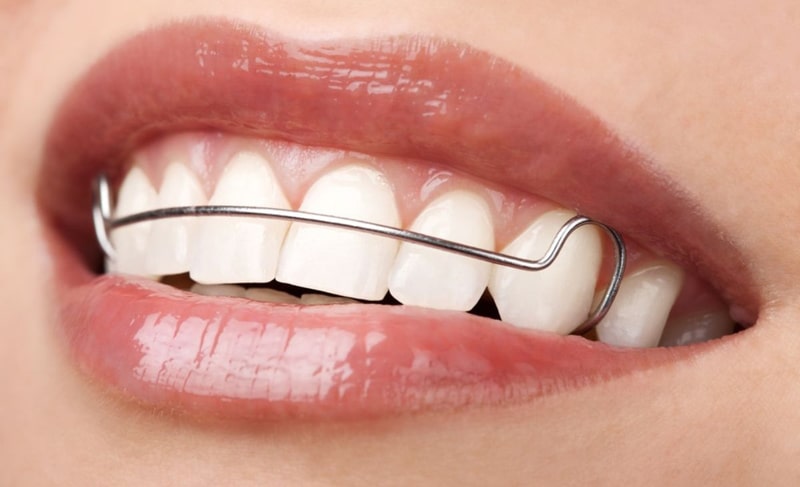 علت فاصله افتادن بین دندانها بعد از ارتودنسی