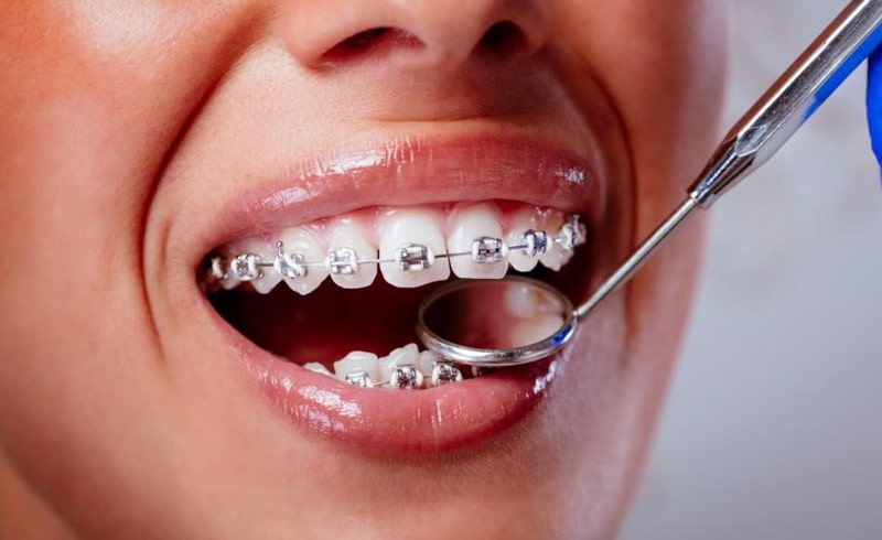 فاصله افتادن بین دندانها بعد از ارتودنسی