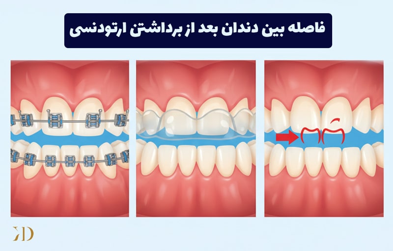 علت ایجاد فاصله بعد از برداشتن ارتودنسی
