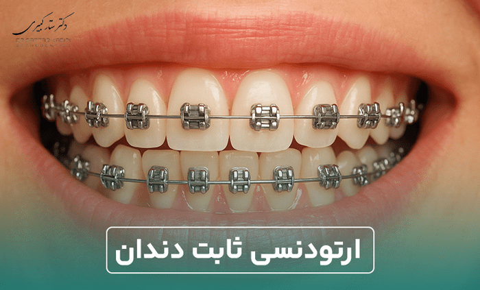 ارتودنسی ثابت دندان