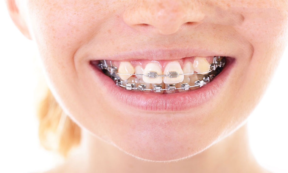 ارتودنشسی مجدد دندان ها