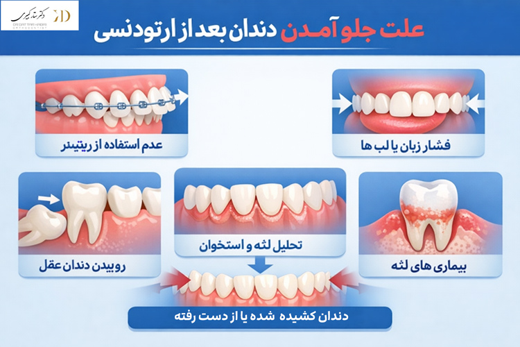 علت جلو آمدن دندان بعد از ارتودنسی