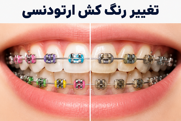 تغییر رنگ کش ارتودنسی دندان