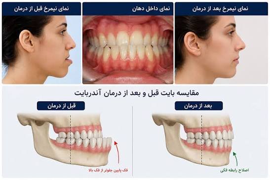 قبل و بعد از درمان آندربایت