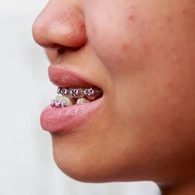 درمان آندربایت با ارتودنسی نامرئی
