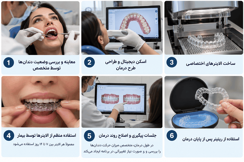 مراحل درمان دیپ بایت با الاینر