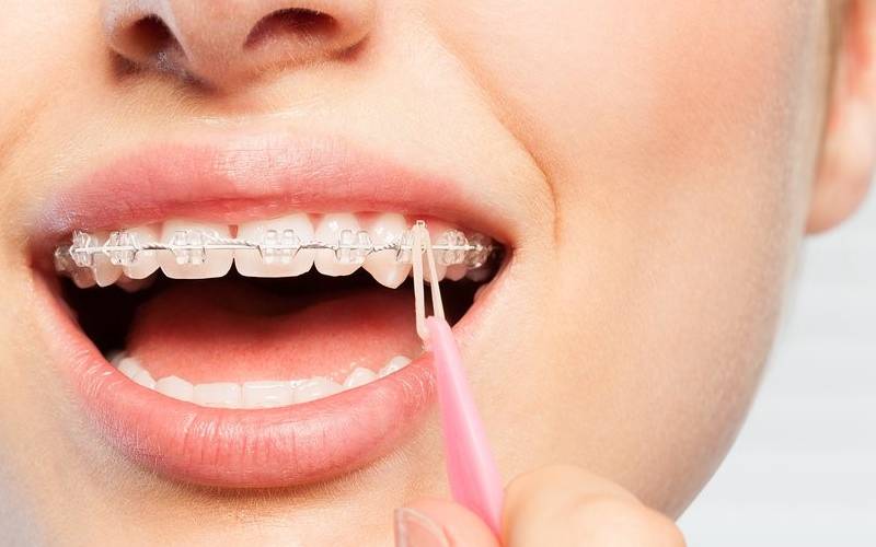 کش ارتودنسی برای اصلاح اوربایت