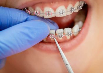 فاصله افتادن بین دندان بعد از ارتودنسی