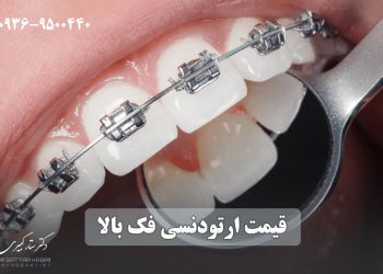 قیمت ارتودنسی دندان فک بالا