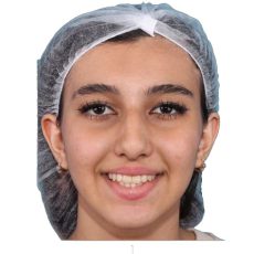 نمونه درمان ارتودنسی با الاینر