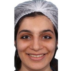 نمونه درمان ارتودنسی ثابت در کرج