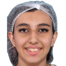 نمونه درمان ارتودنسی با الاینر