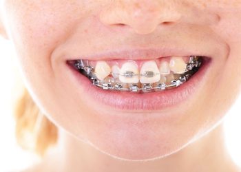 ارتودنشسی مجدد دندان ها