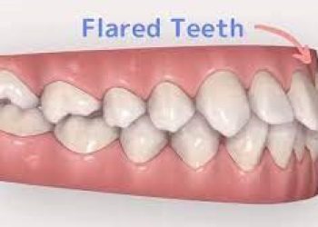 جلو امدن دنان بعد ارتودنسی